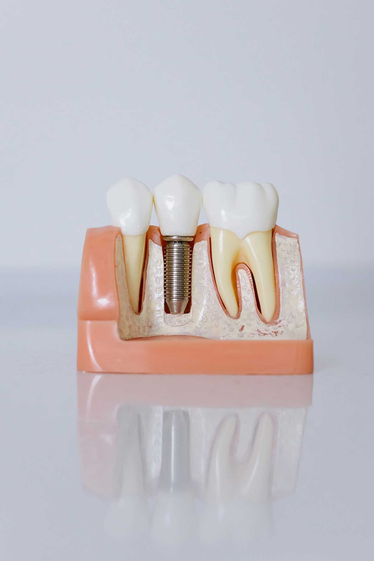 Dental implant example