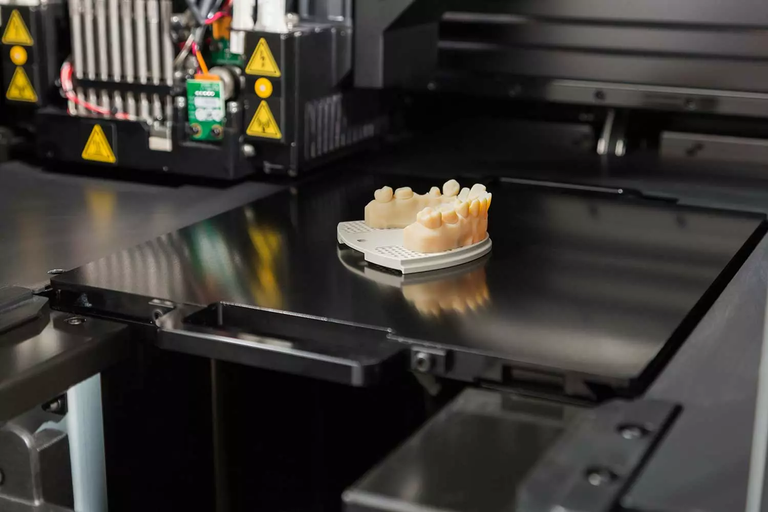 3D Printed Dental Implant