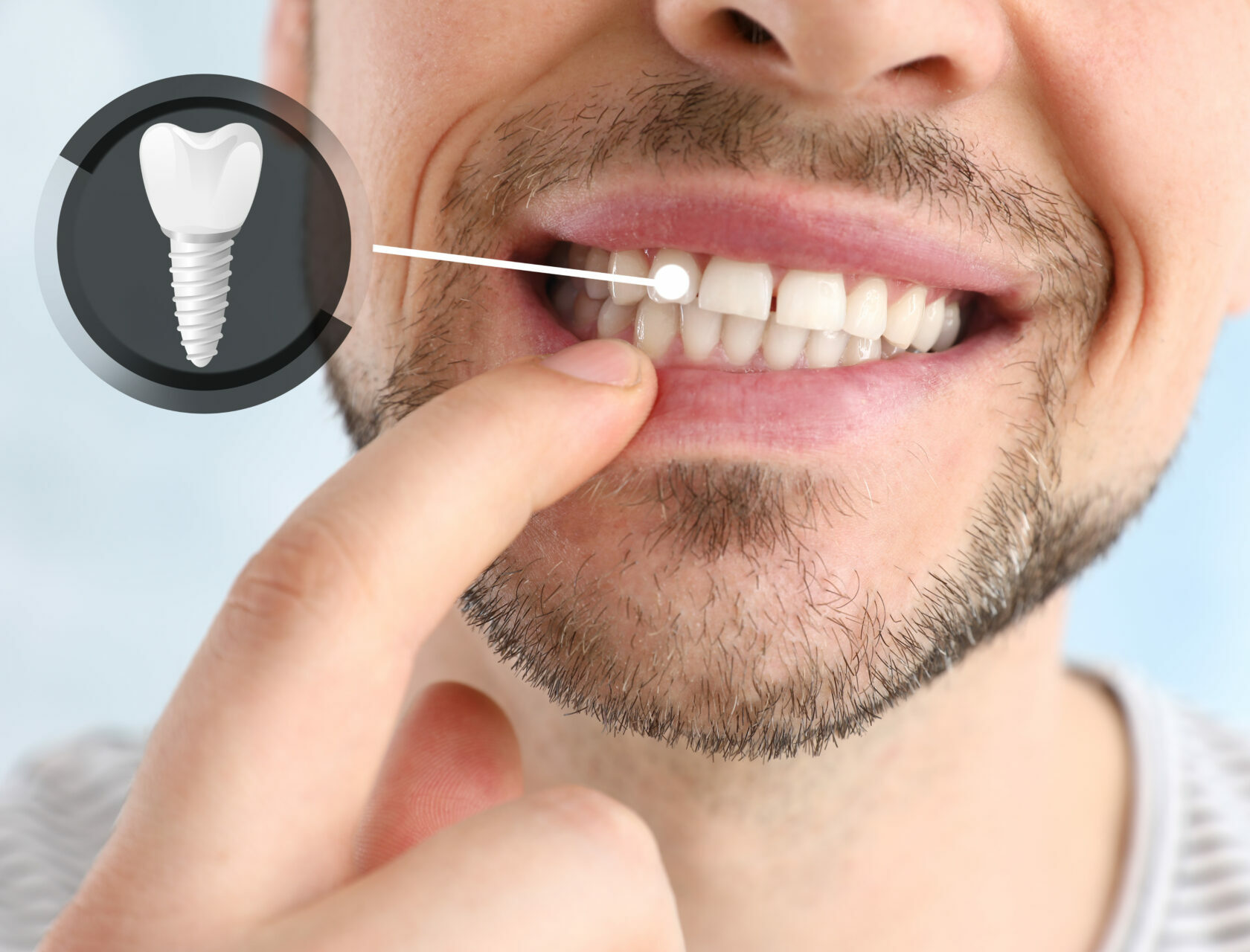 Man showing implanted teeth on light background, closeup